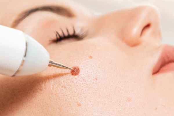 CryoPen: 5 Skin Concerns It May Be Used to Treat 3 What actually happens during a CryoPen treatment Far Coton?