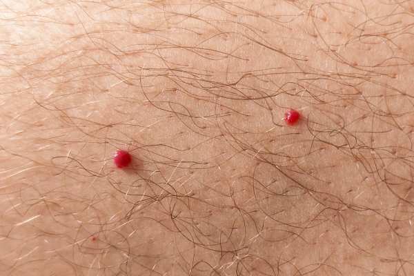 CryoPen: 5 Skin Concerns It May Be Used to Treat 2 cherry angioma removal Far Coton