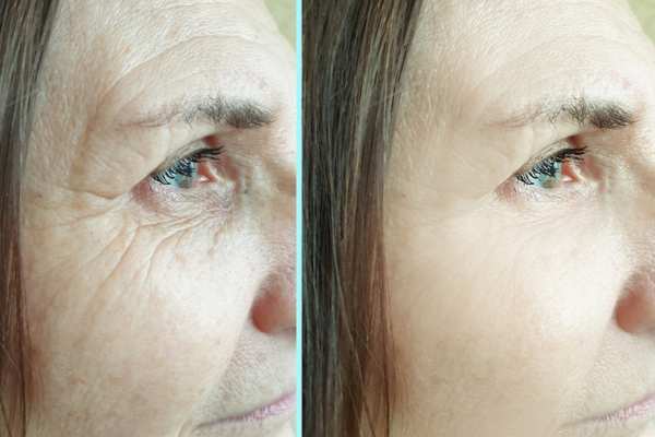 Why Do People Choose HIFU for a Non-Surgical Facelift? 4 How long can HIFU results last Far Coton?