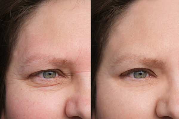 HIFU vs Botulinum Toxin: Understanding the Differences 4 How long do HIFU results last Far Coton?