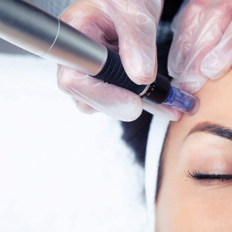 Morpheus8 treatment Far Coton from Lipo Sculpt - Book in today!