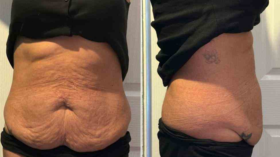 Lost the Weight but Not the Loose Skin? What You Should Know 1 Is It Definitely Loose Skin Far Coton?